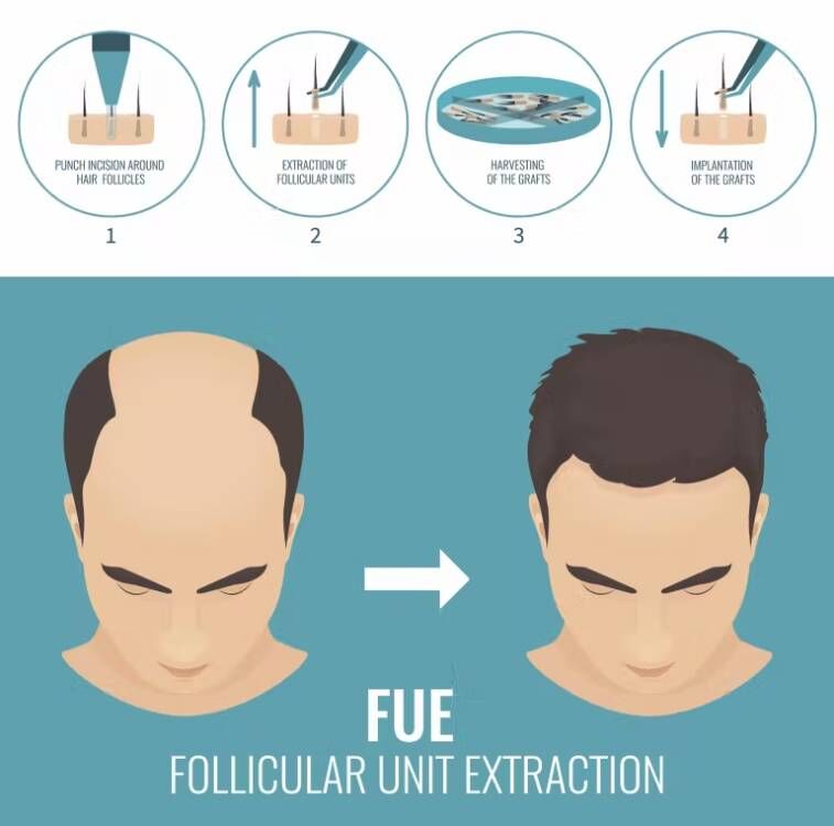 Implant do włosów FUE mikro si – Hair Care Basic recenzja i cena